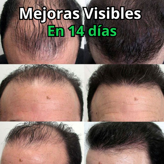 OUHOE POTENCIADOR DE CRECIMIENTO DE CABELLO ⭐⭐⭐⭐⭐